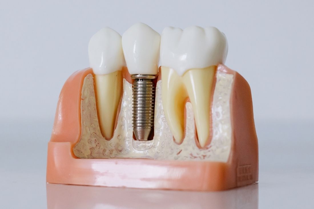 A dental implant model showing two artificial teeth and a central screw surrounded by gum and bone tissue.